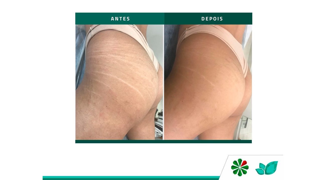 before and after pic