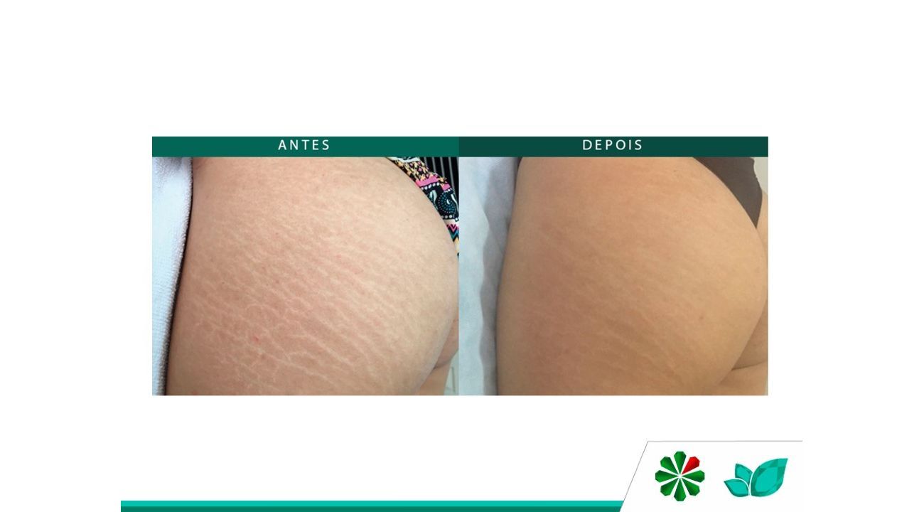 stretch mark before and after